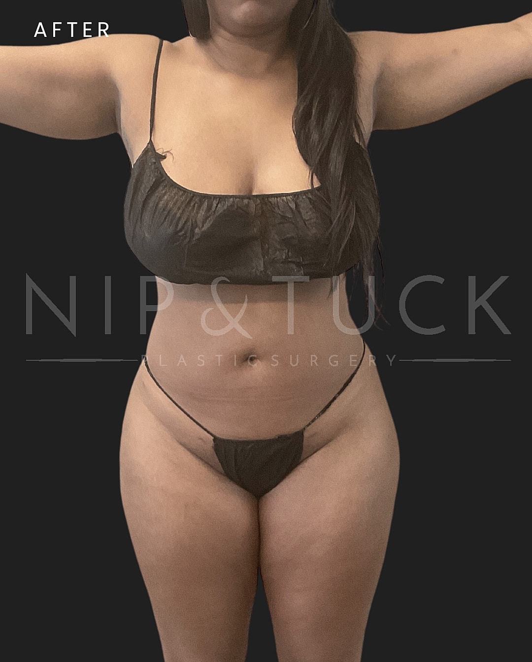 Vaser Liposuction Before & After