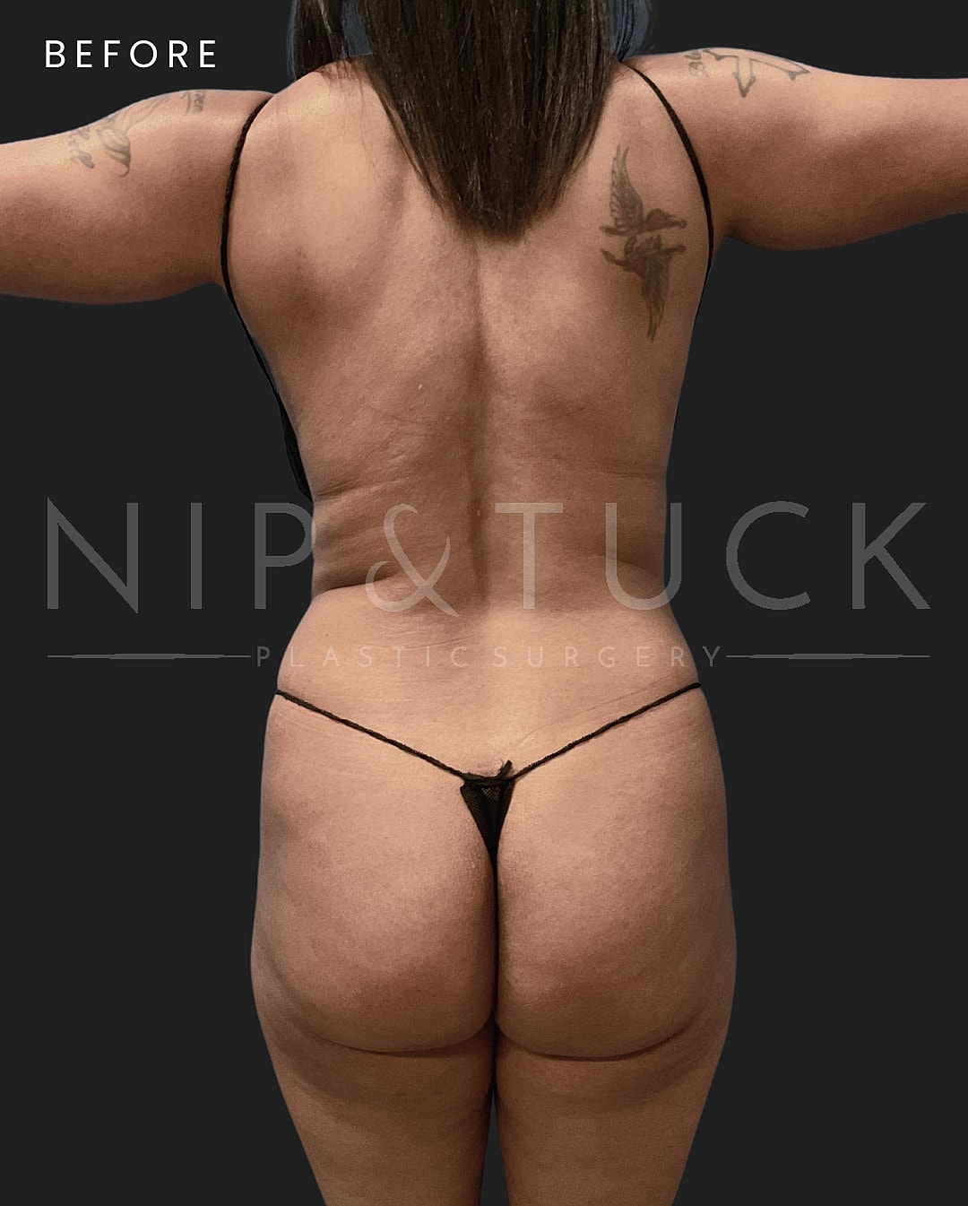 Vaser Liposuction Before & After