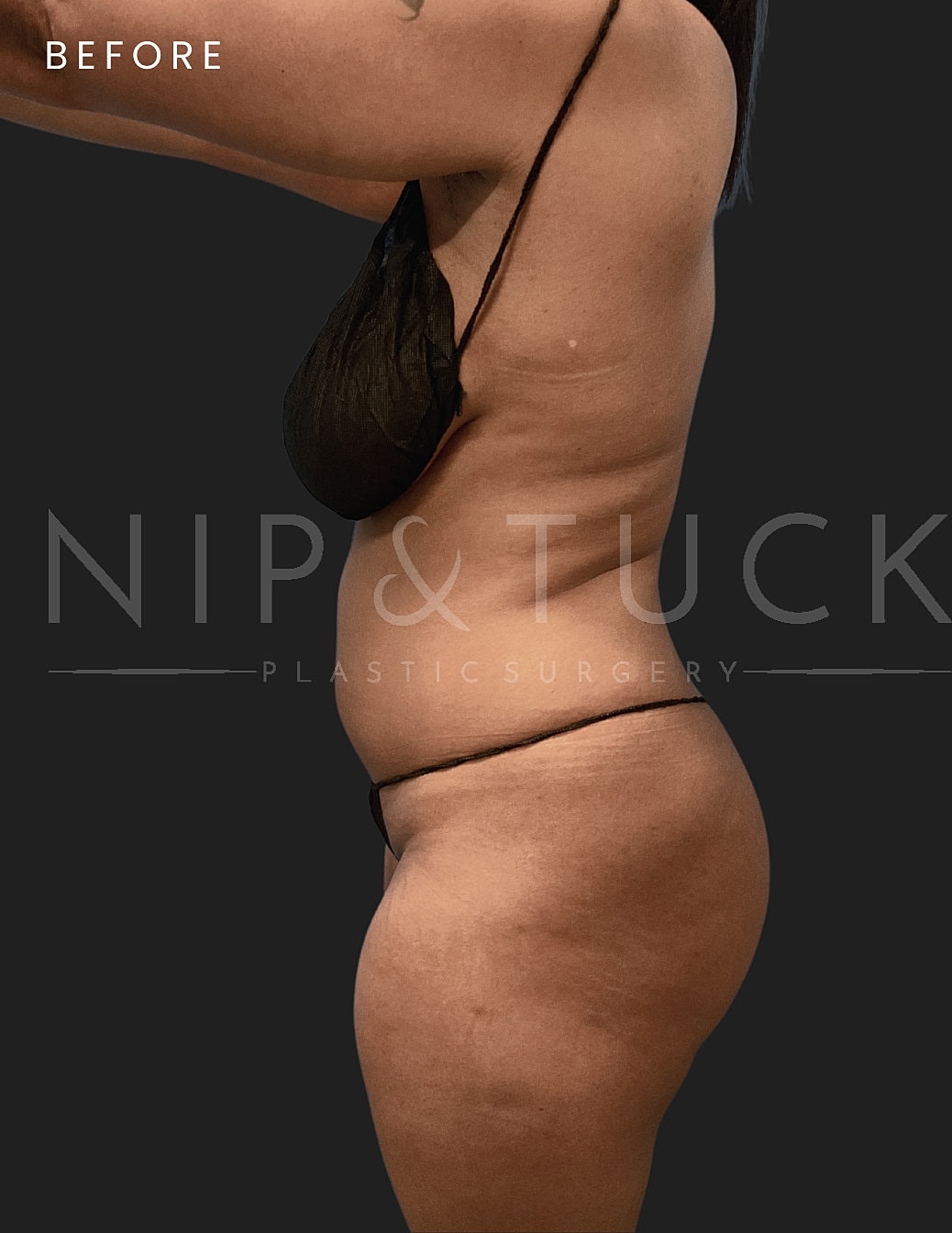 Vaser Liposuction Before & After