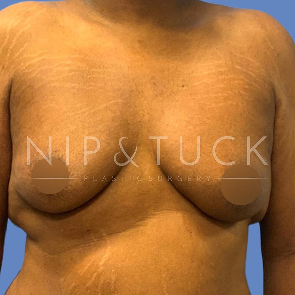Gynecomastia Before & After