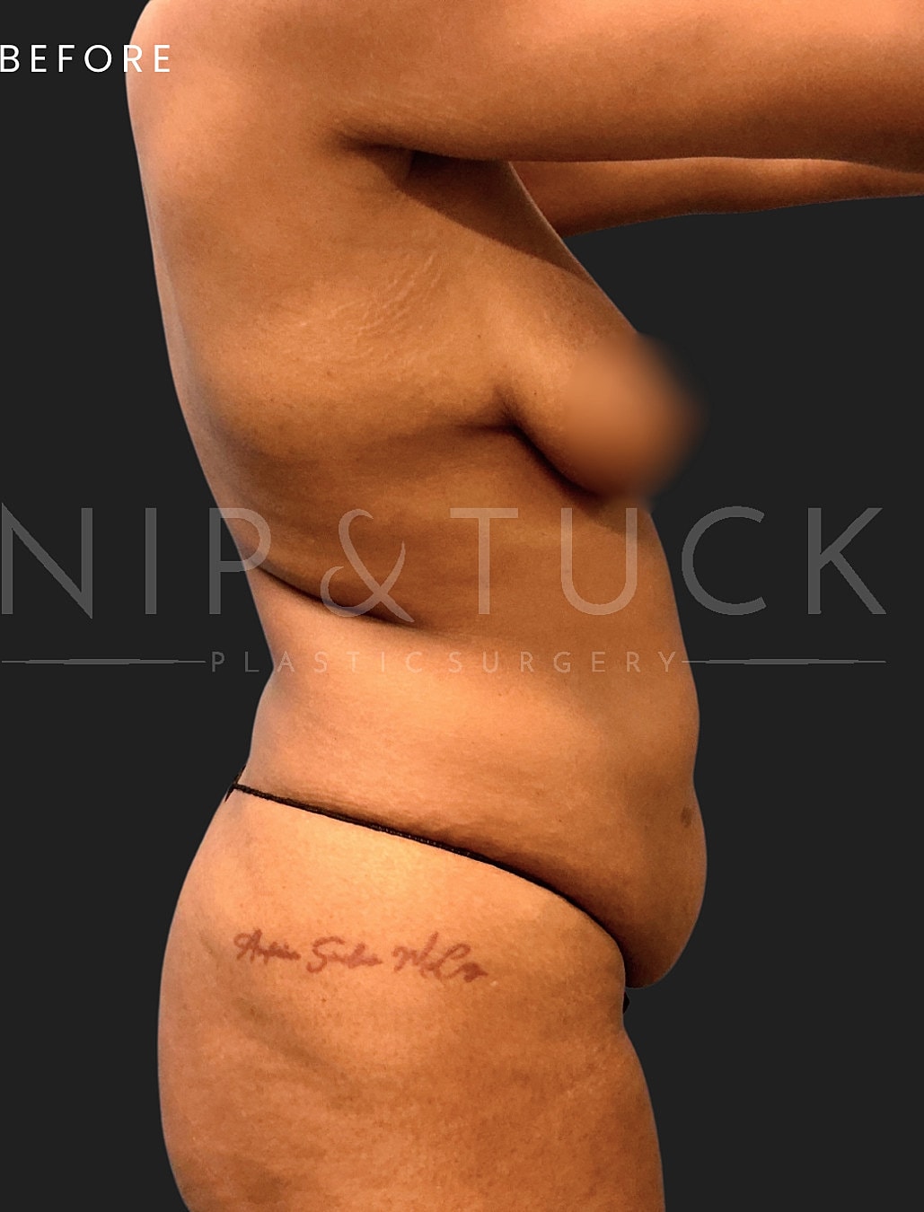Breast Lift Before & After