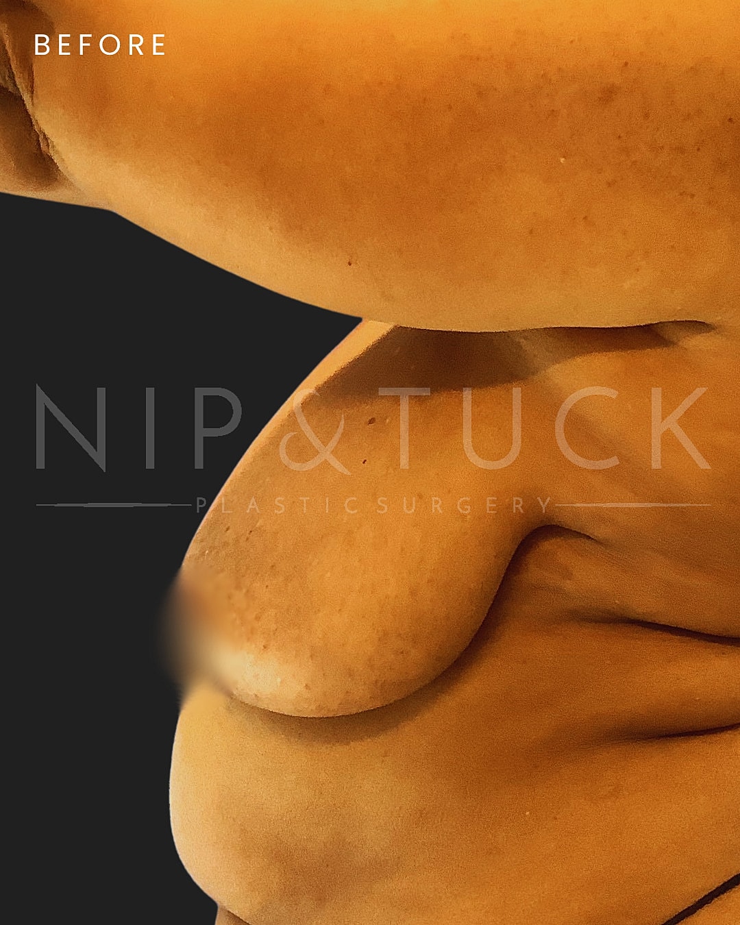 Breast Lift Before & After