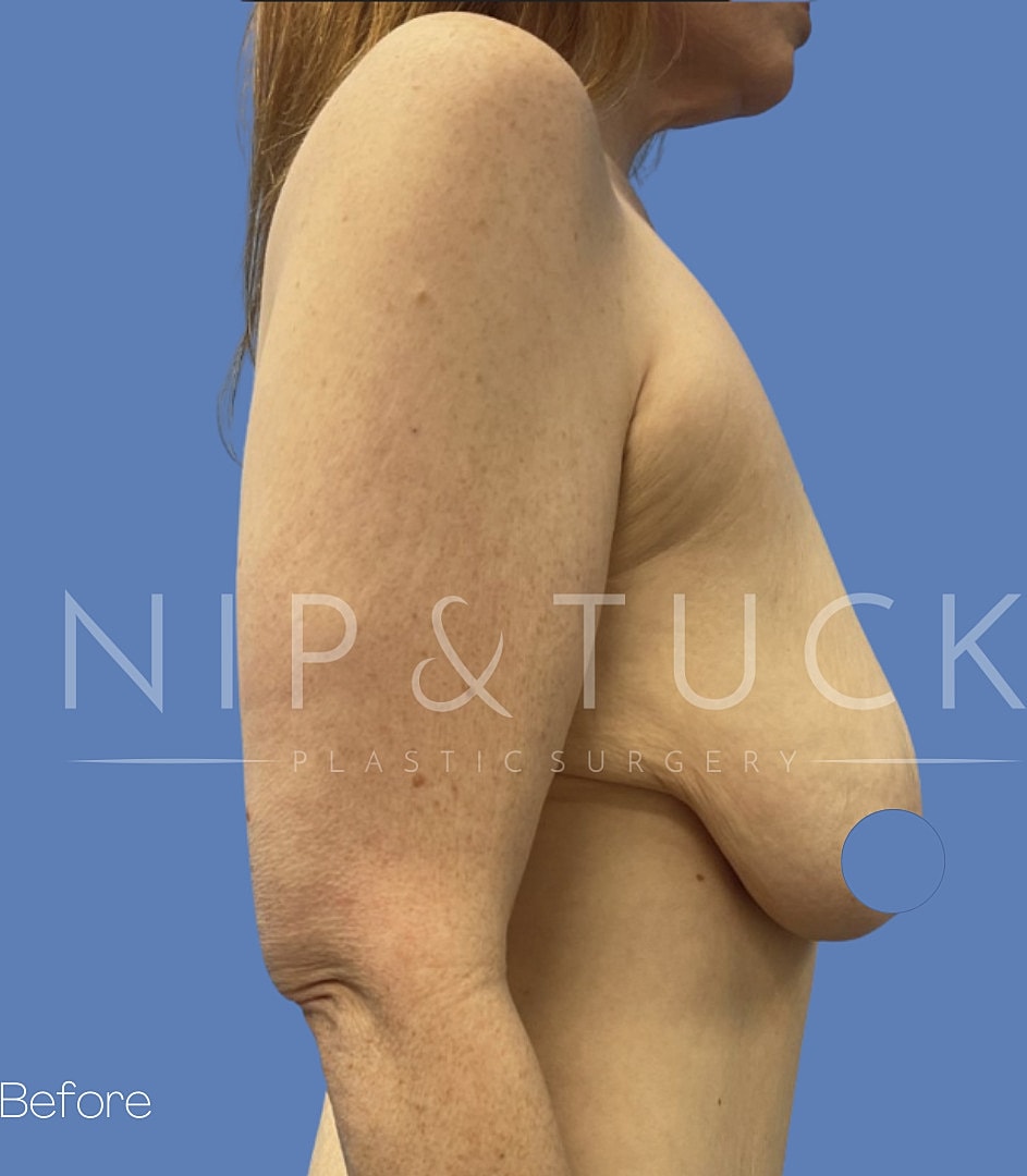Breast Lift Before & After