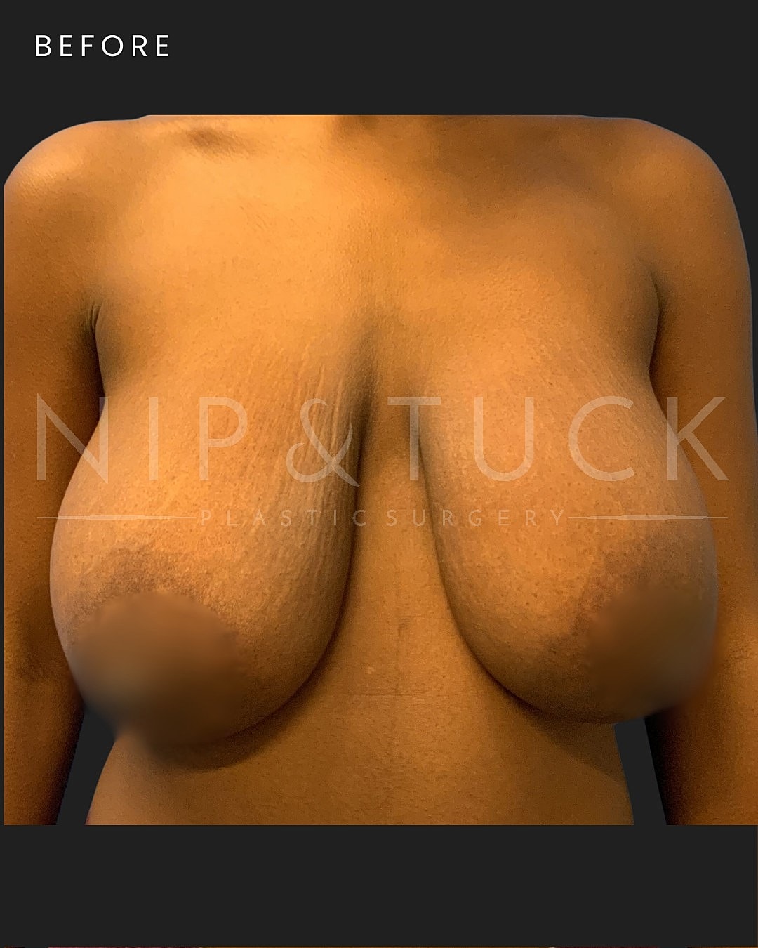 Breast Lift Before & After