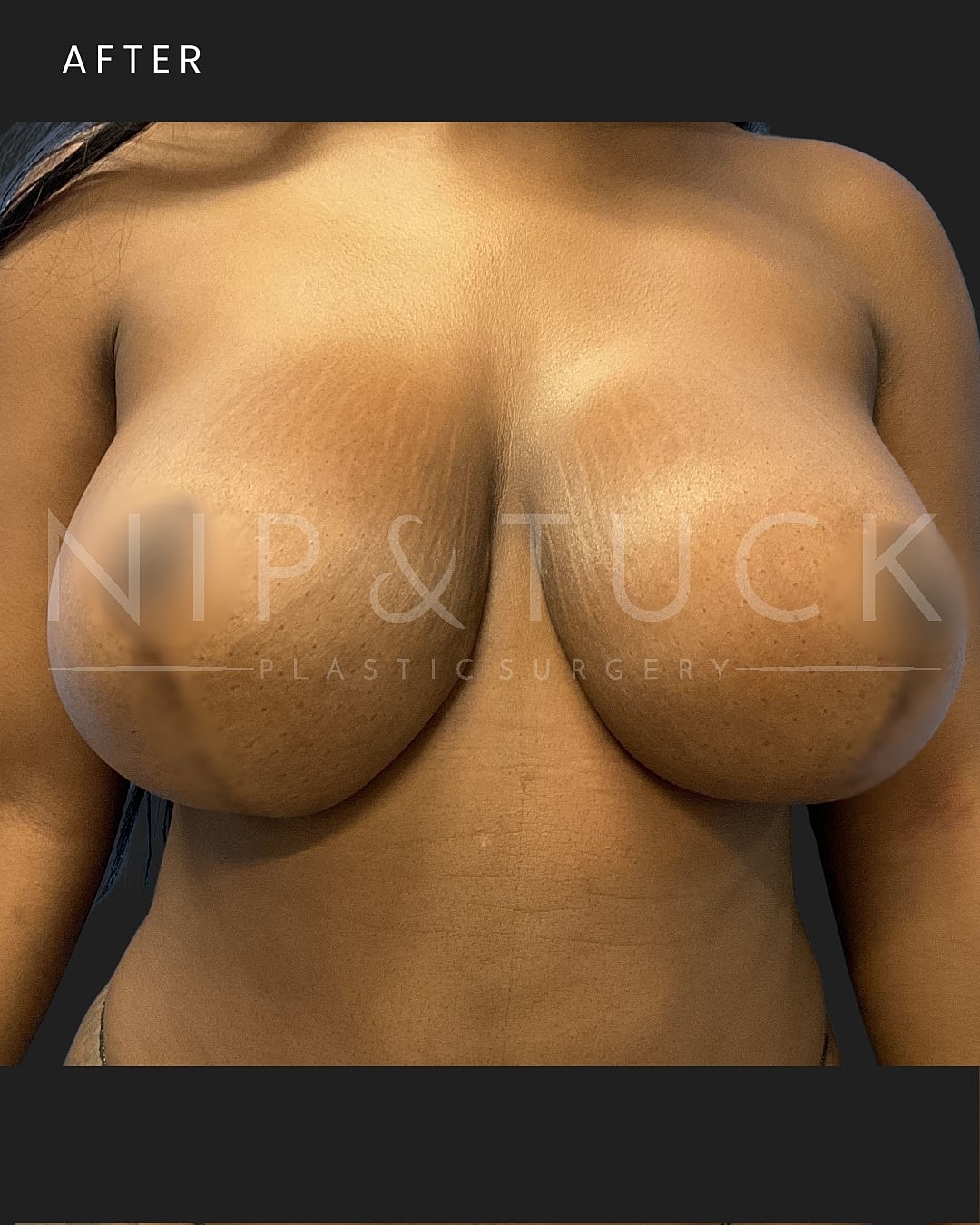 Breast Lift Before & After