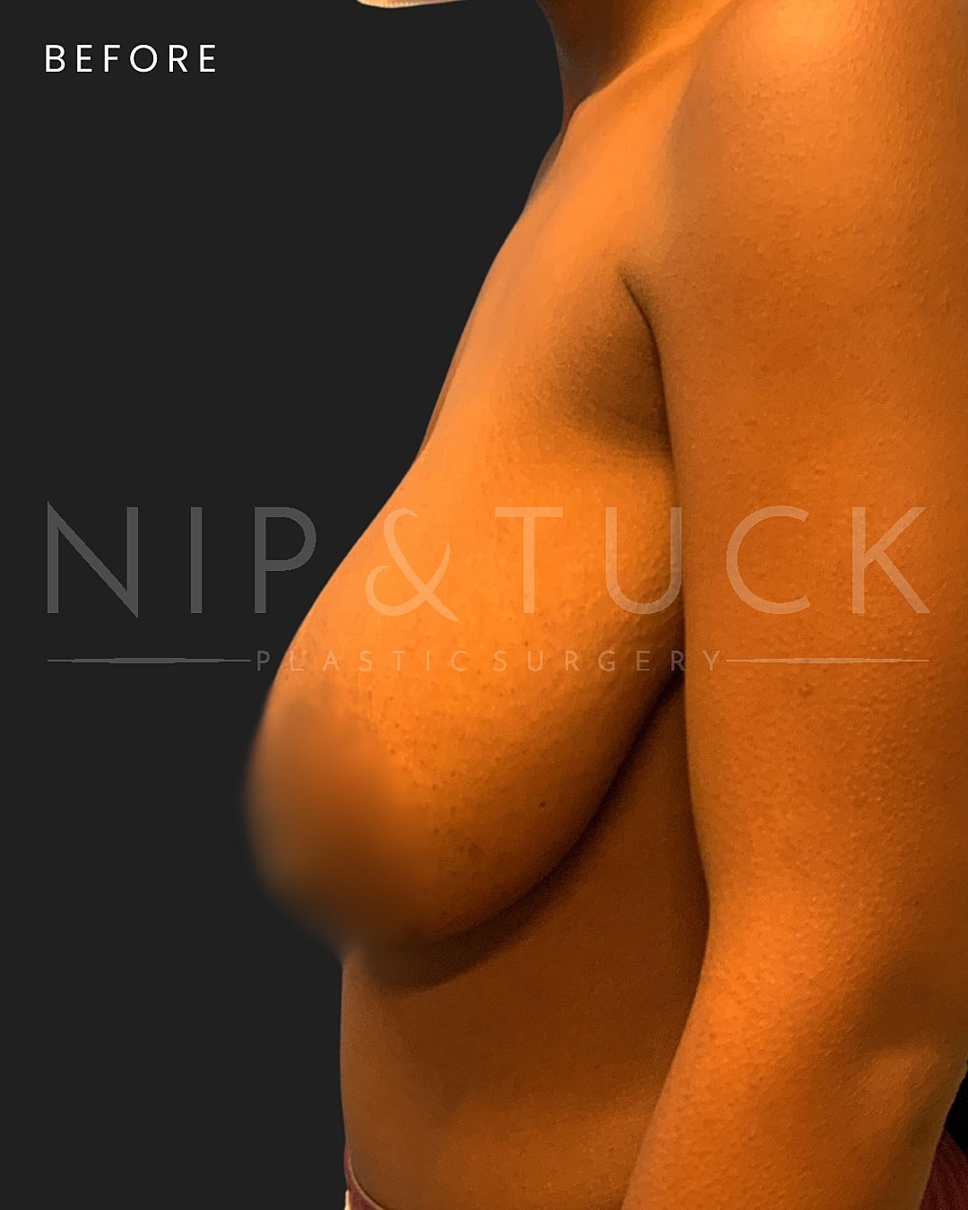 Breast Lift Before & After