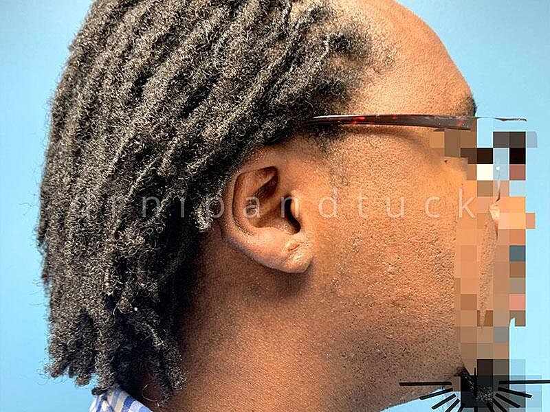 Keloid Excision Before & After