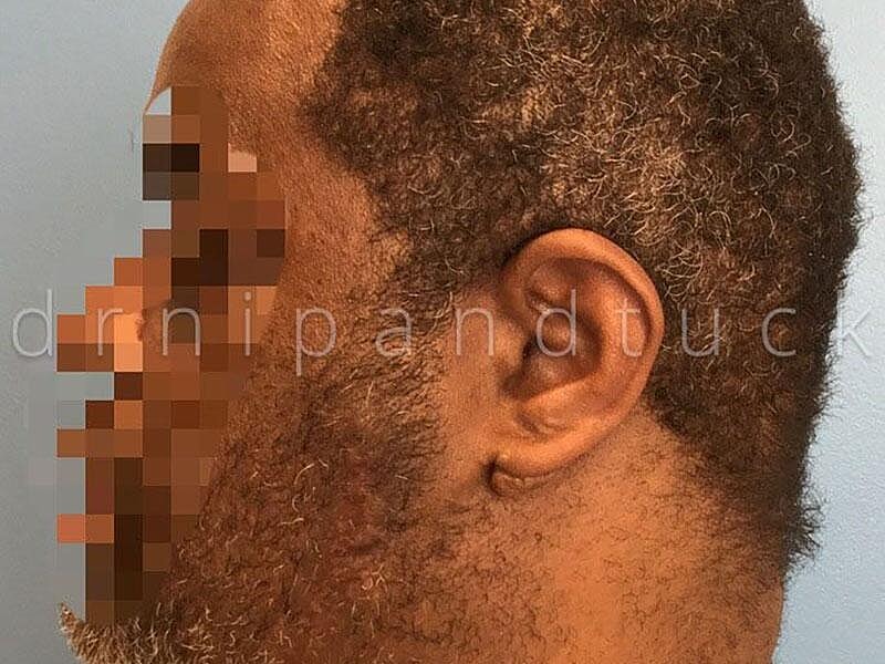 Keloid Excision Before & After