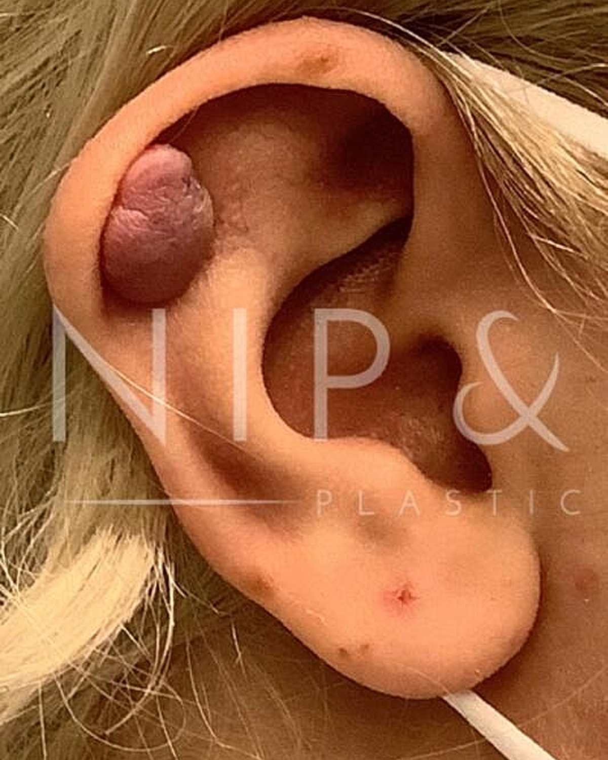 Ear with skin growth and blemishes.