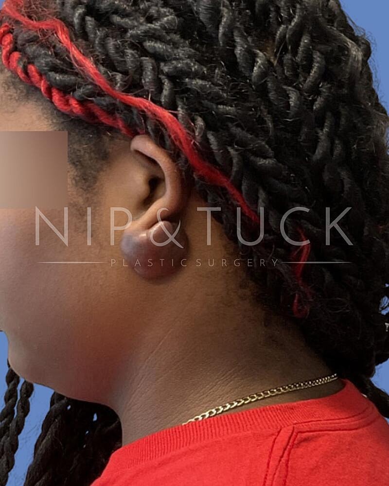 Keloid Excision Before & After