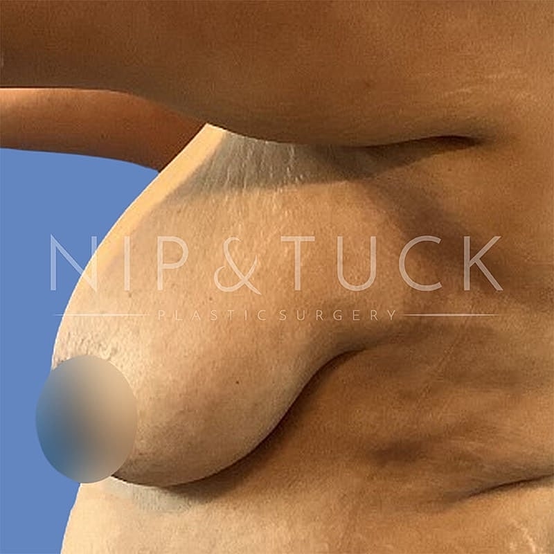 Breast Reduction Before & After