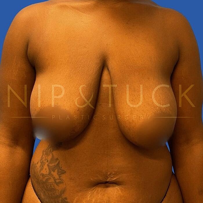 Breast Reduction Before & After