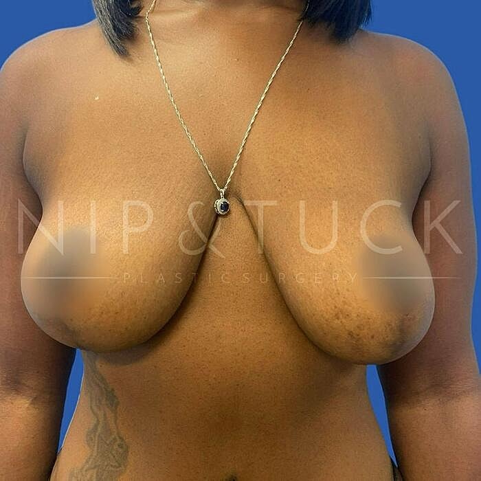Breast Reduction Before & After