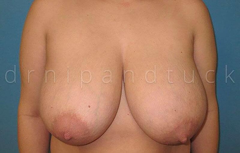 Breast Reduction Before & After