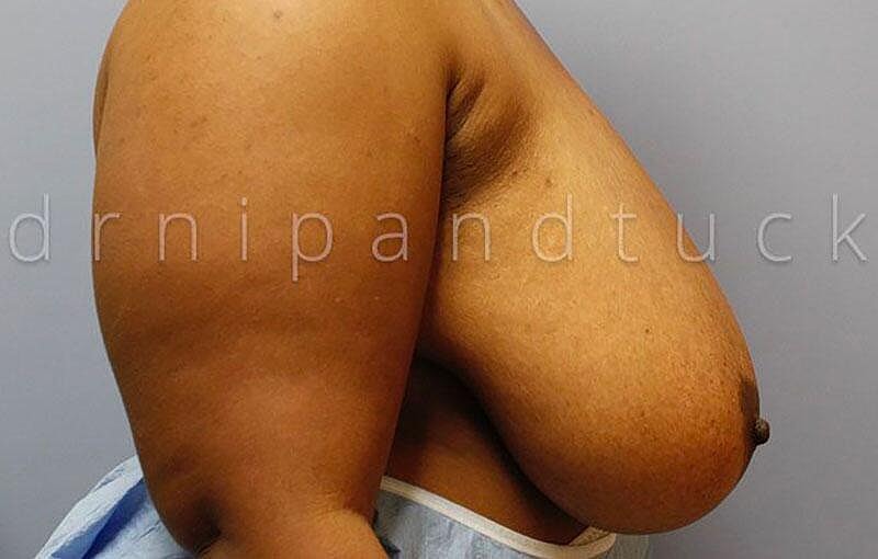 Breast Reduction Before & After