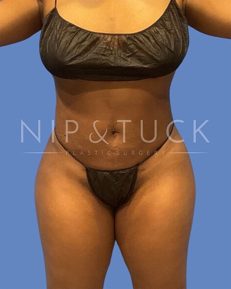 Brazilian Butt Lift Before & After