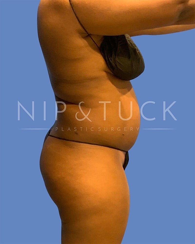 Brazilian Butt Lift Before & After