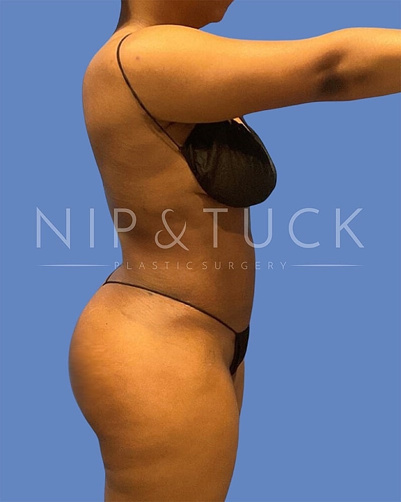 Brazilian Butt Lift Before & After
