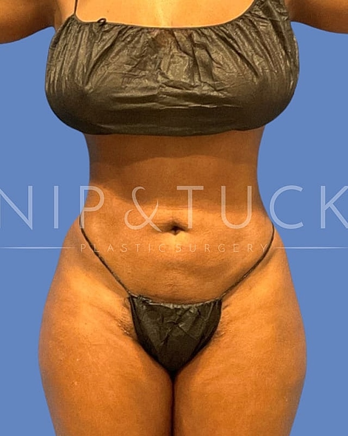 Brazilian Butt Lift Before & After