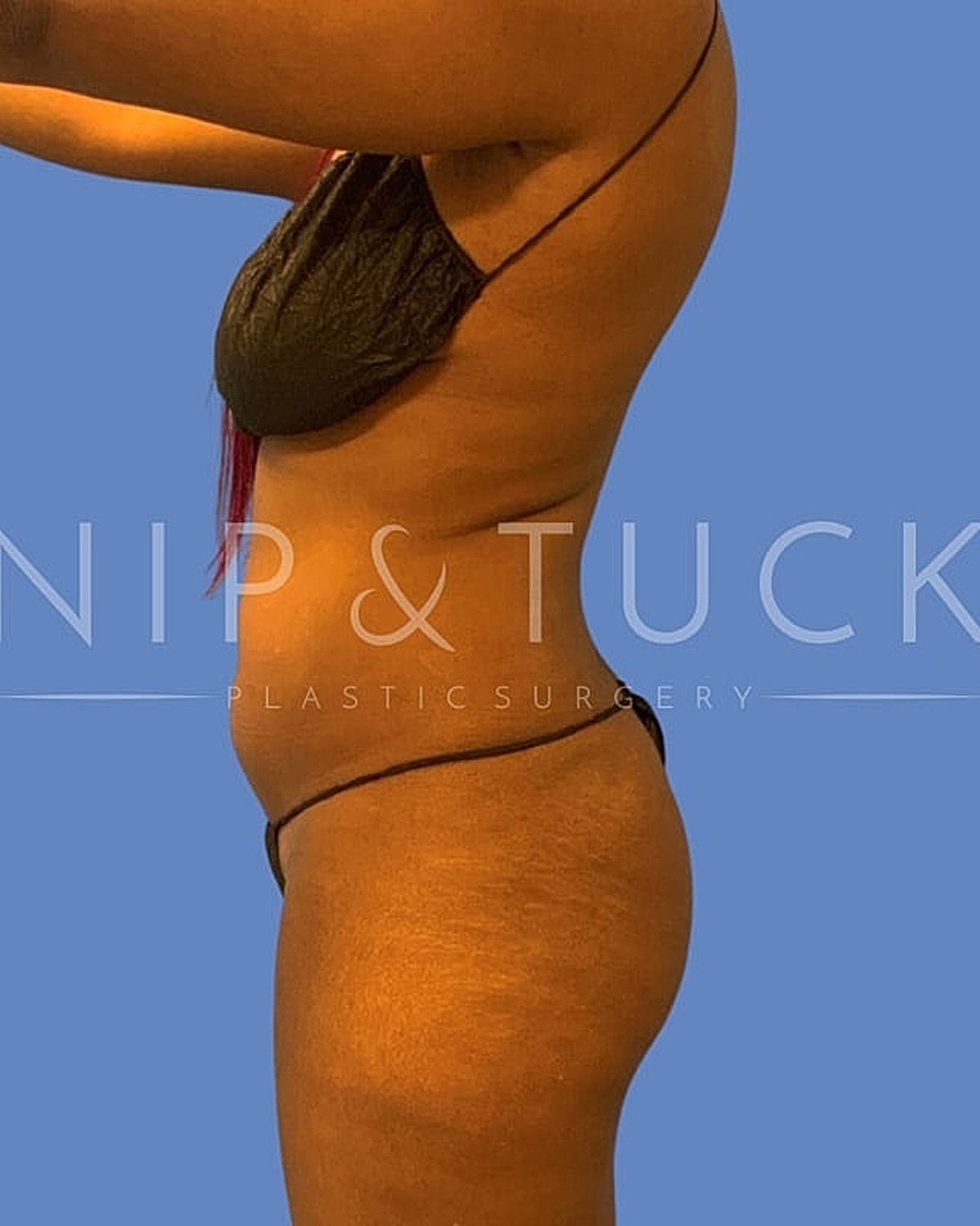 Brazilian Butt Lift Before & After