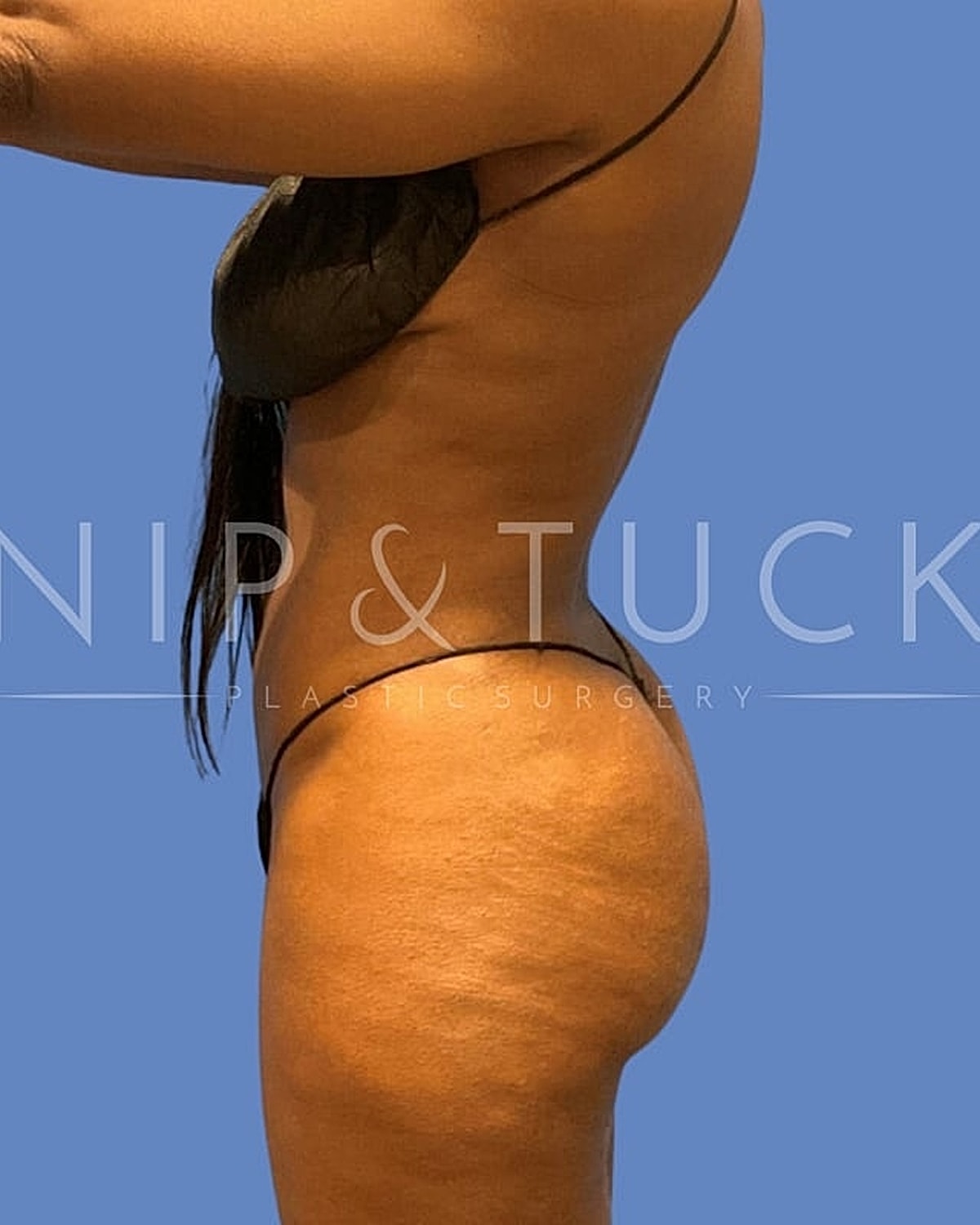 Brazilian Butt Lift Before & After