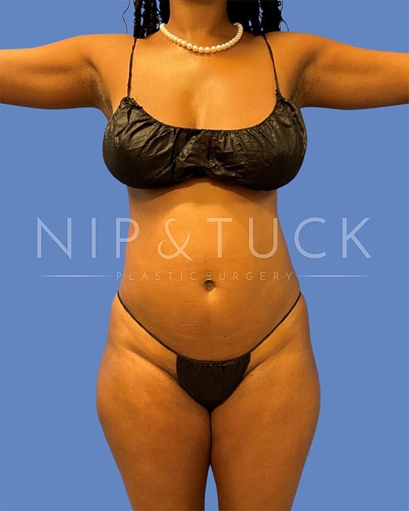 Brazilian Butt Lift Before & After