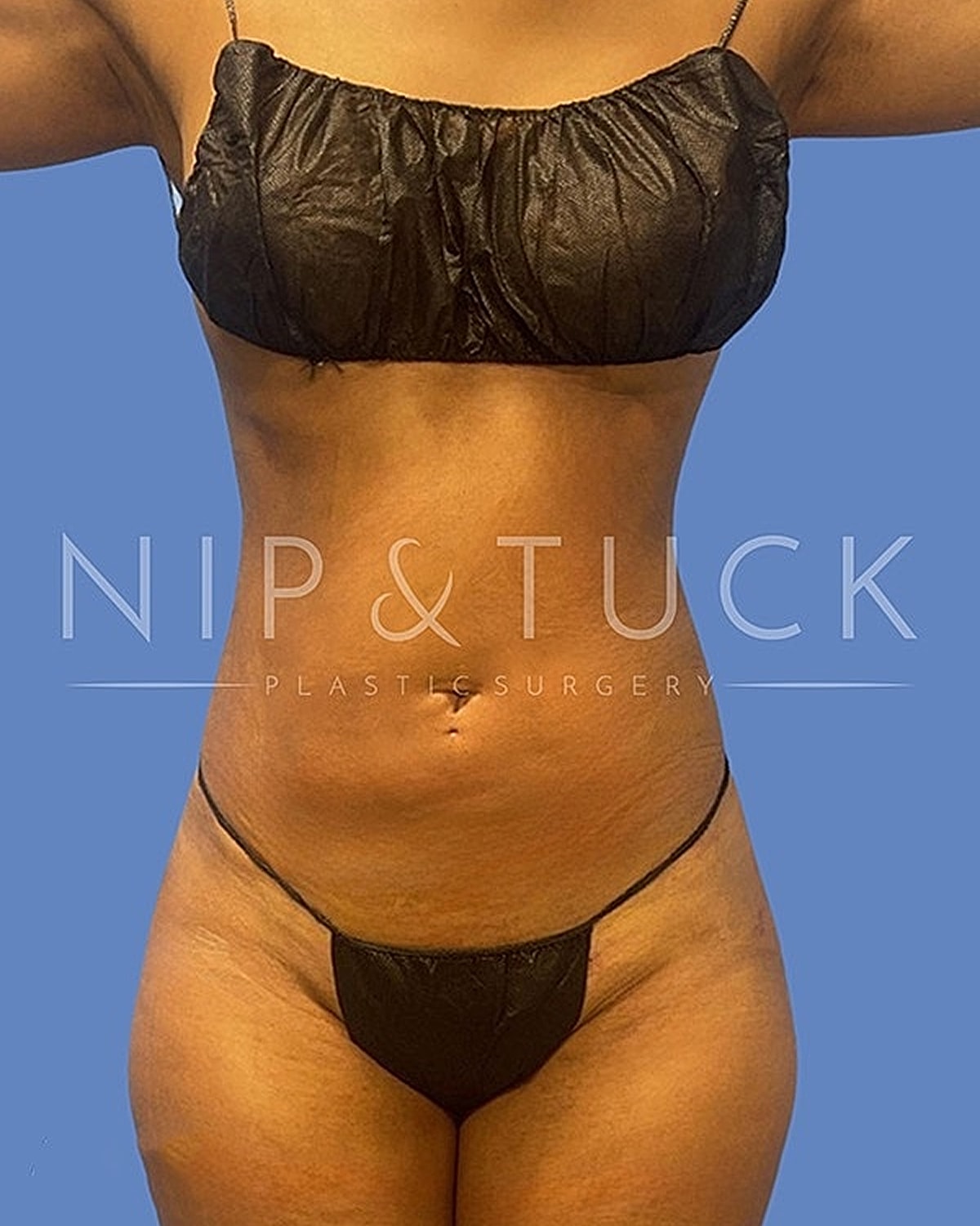 Brazilian Butt Lift Before & After