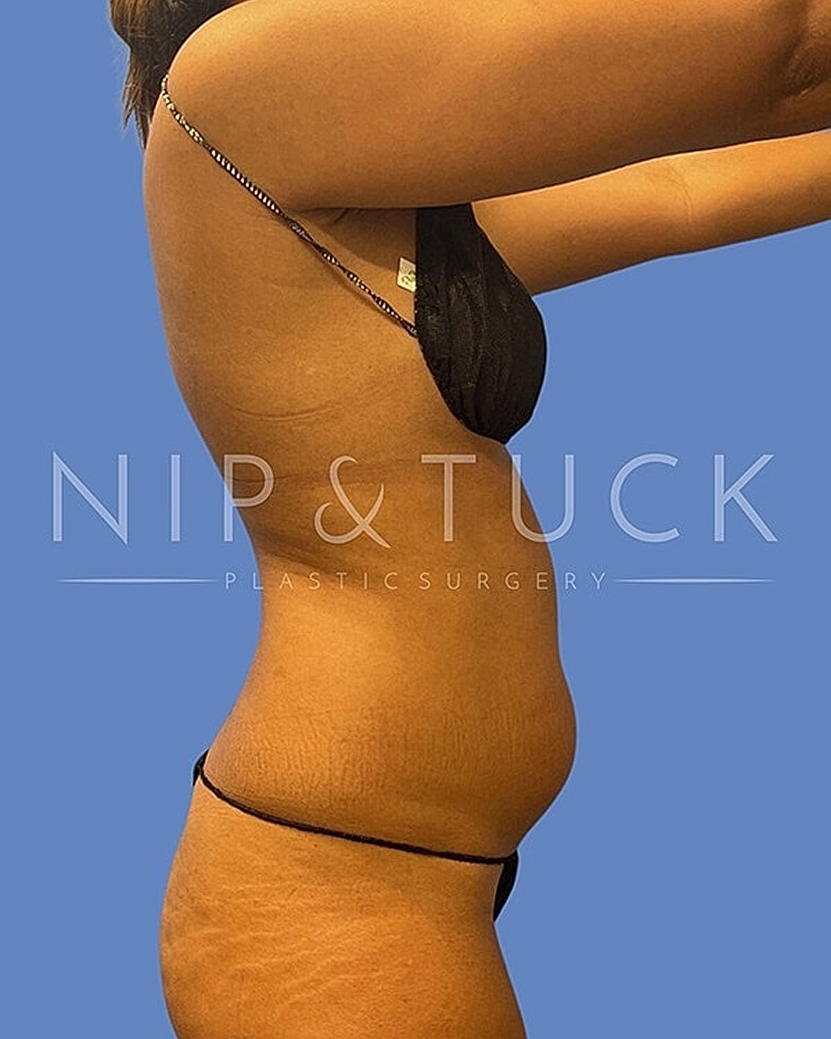 Brazilian Butt Lift Before & After