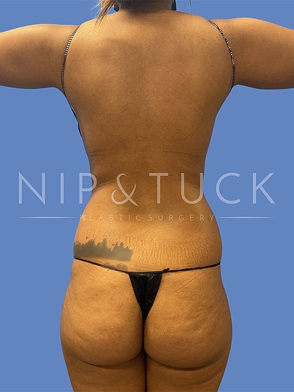 Brazilian Butt Lift Before & After
