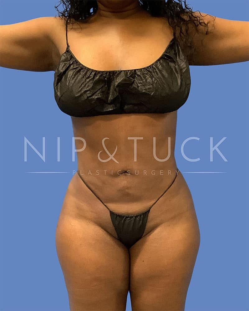 Brazilian Butt Lift Before & After