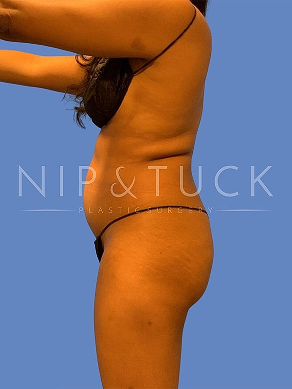 Brazilian Butt Lift Before & After