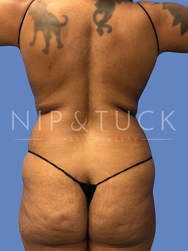 Brazilian Butt Lift Before & After