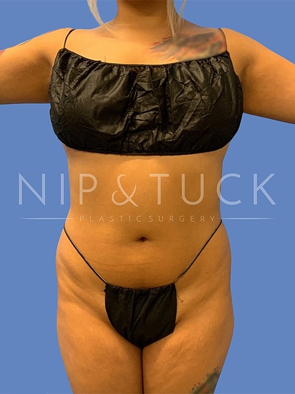 Brazilian Butt Lift Before & After