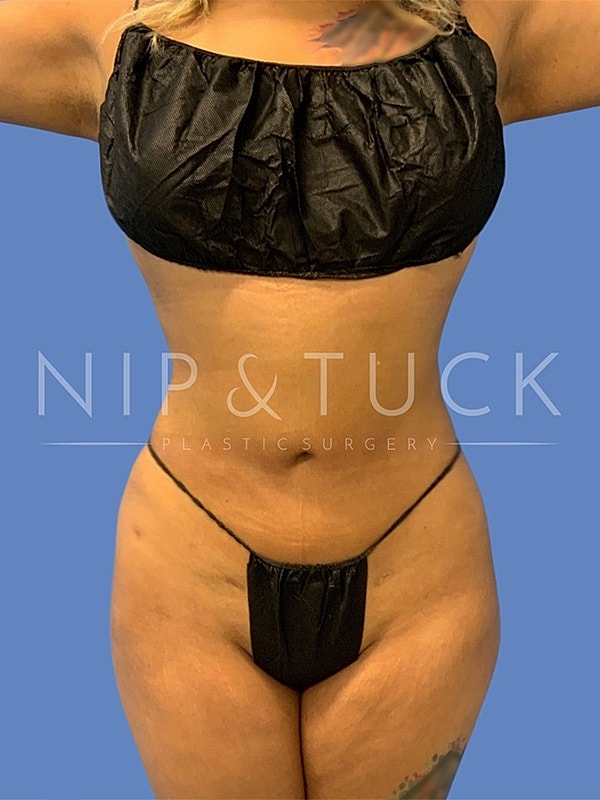 Brazilian Butt Lift Before & After