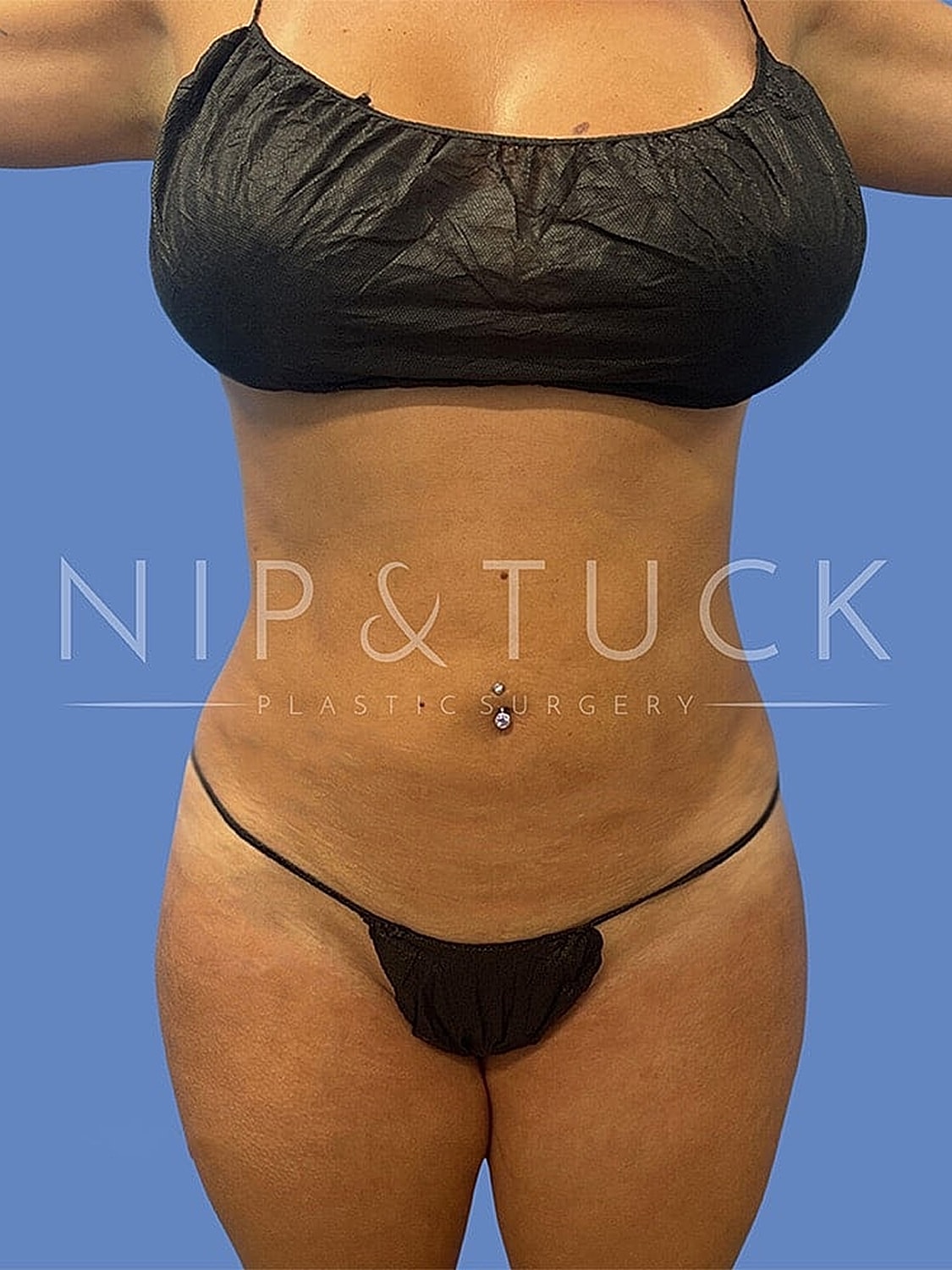 Brazilian Butt Lift Before & After