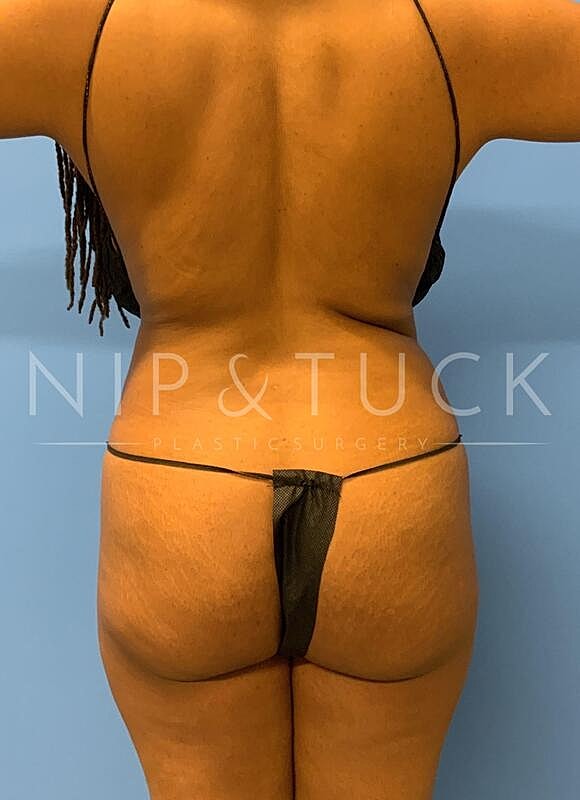 Brazilian Butt Lift Before & After
