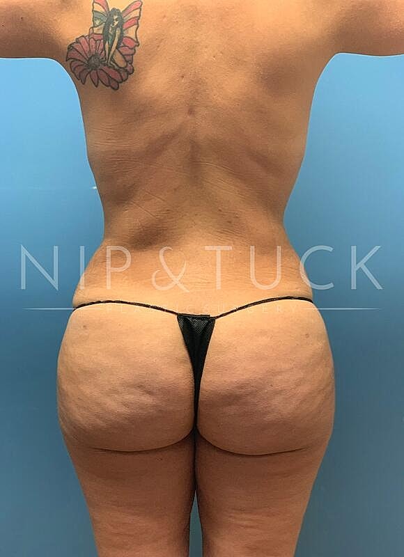 Brazilian Butt Lift Before & After