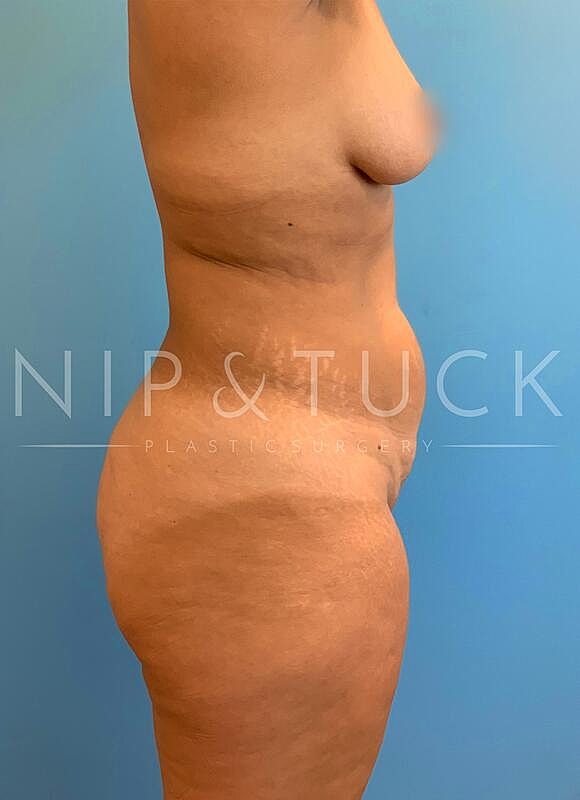 Brazilian Butt Lift Before & After