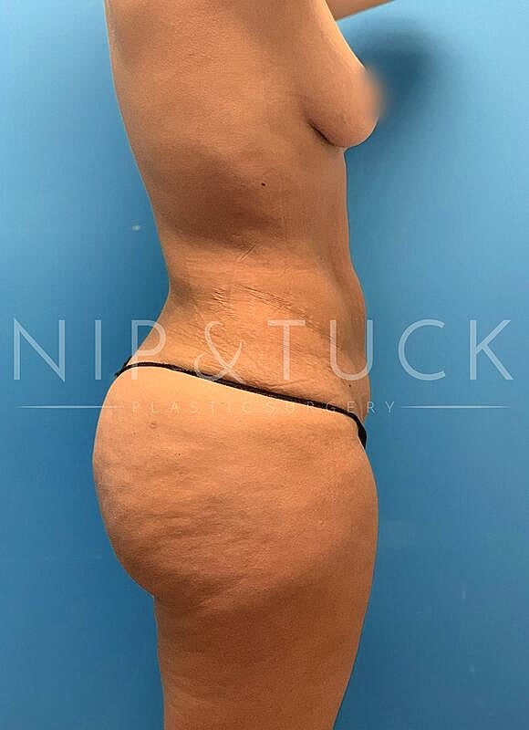 Brazilian Butt Lift Before & After