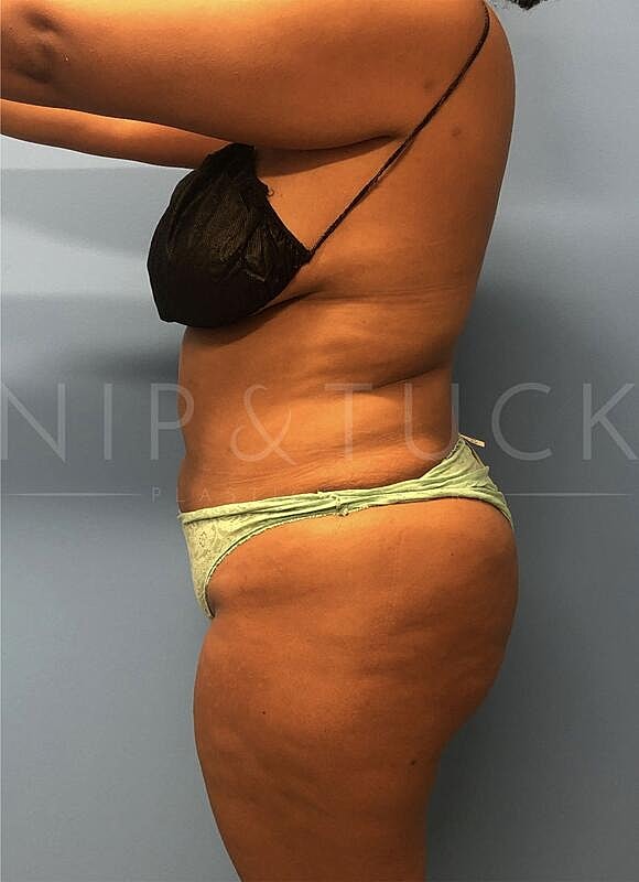 Brazilian Butt Lift Before & After