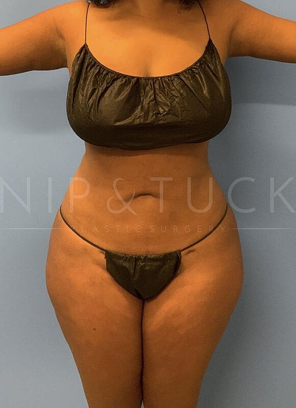 Brazilian Butt Lift Before & After