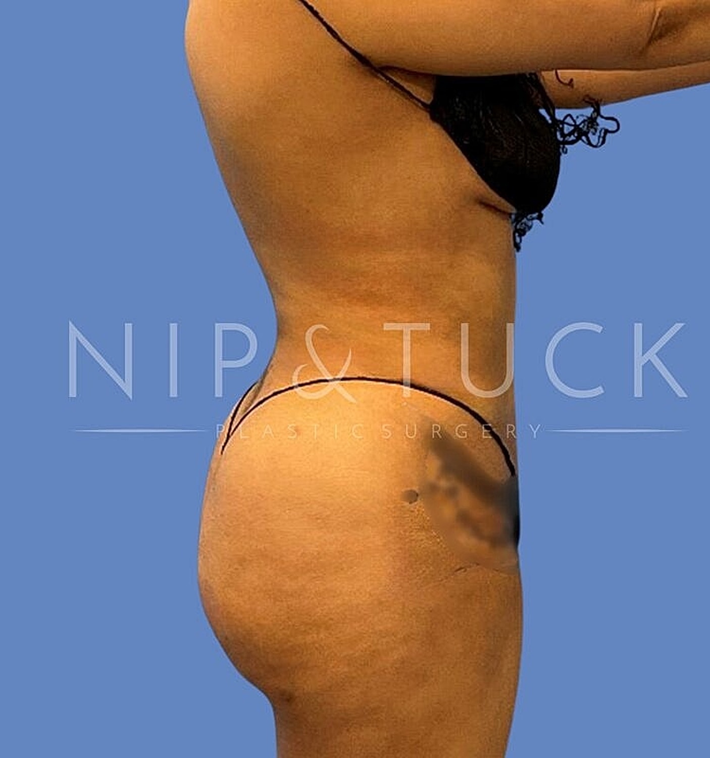 Brazilian Butt Lift Before & After