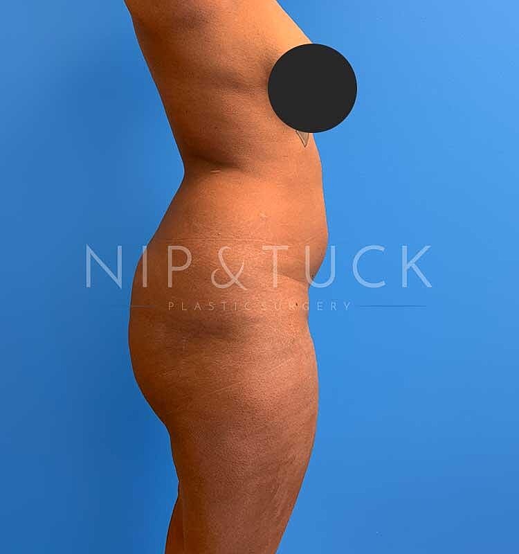 Brazilian Butt Lift Before & After