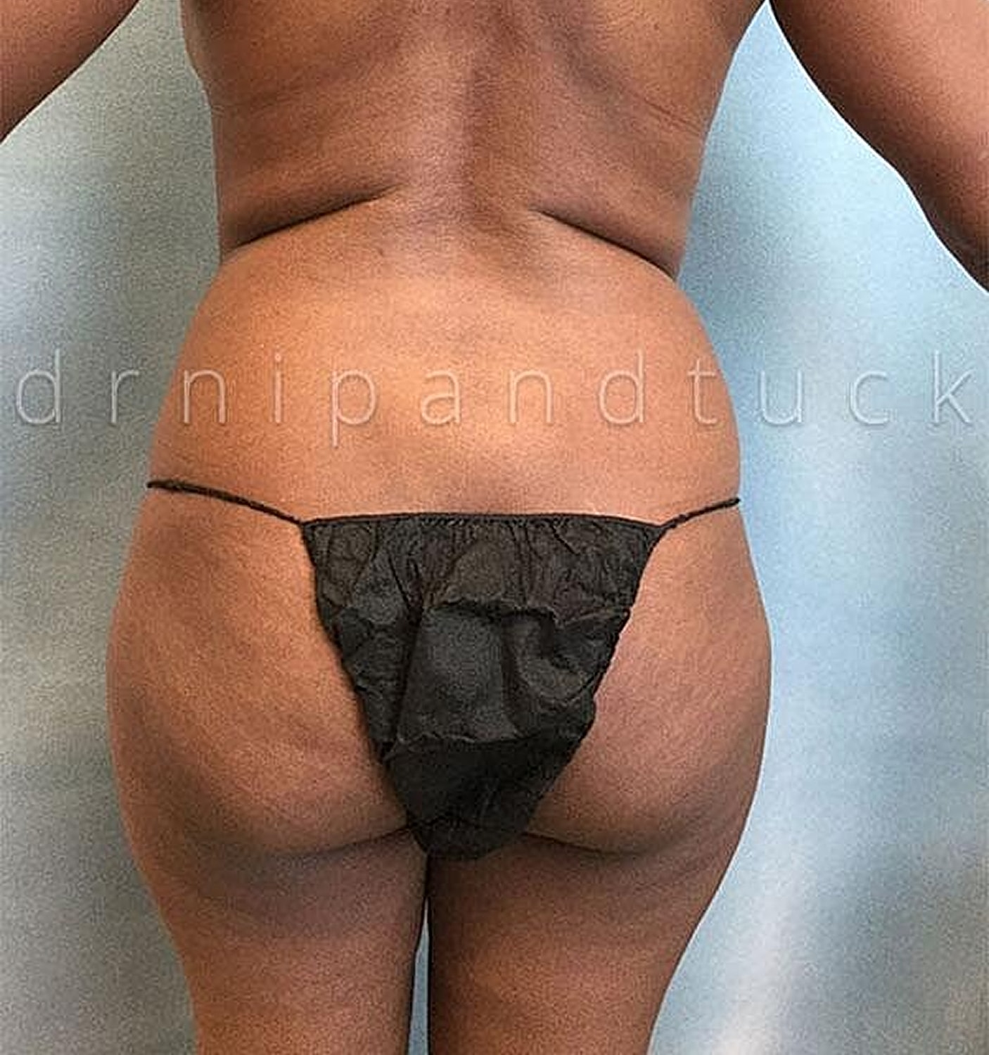 Brazilian Butt Lift Before & After