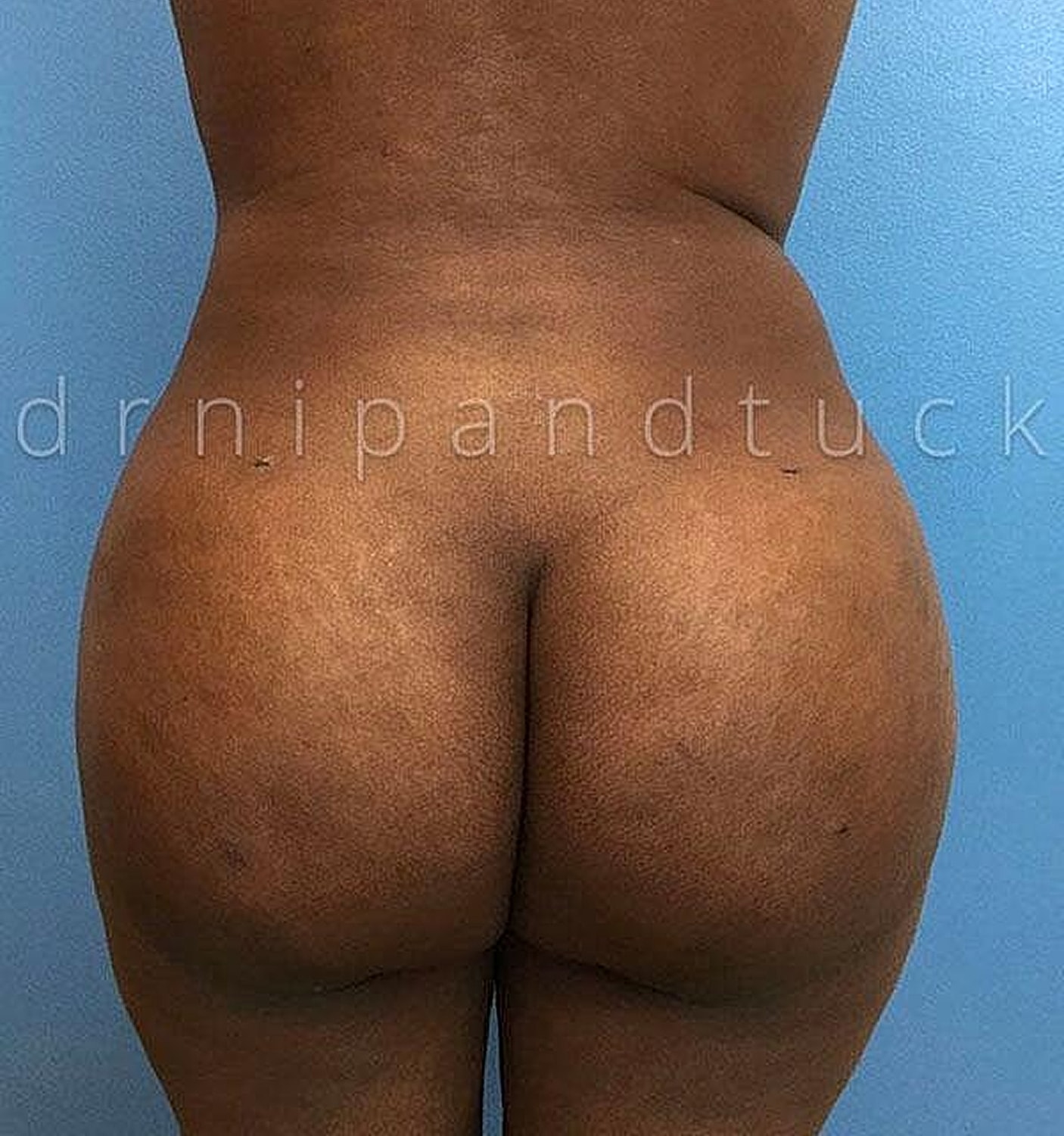 Brazilian Butt Lift Before & After