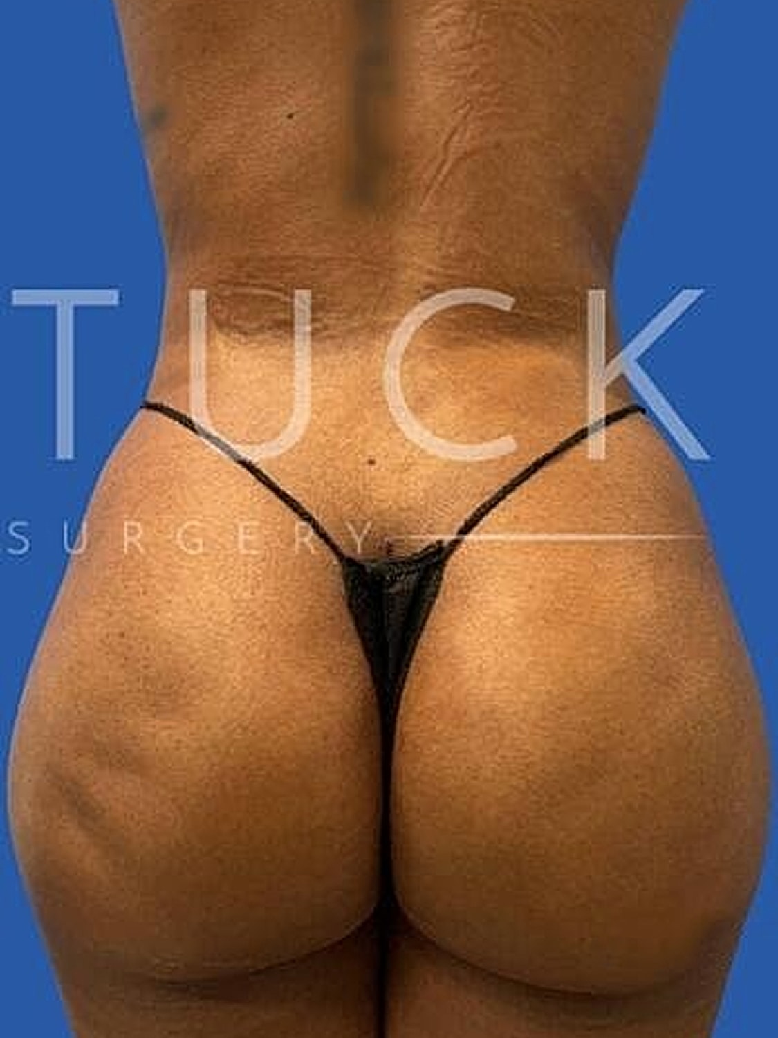 Body transformation after cosmetic surgery procedure.