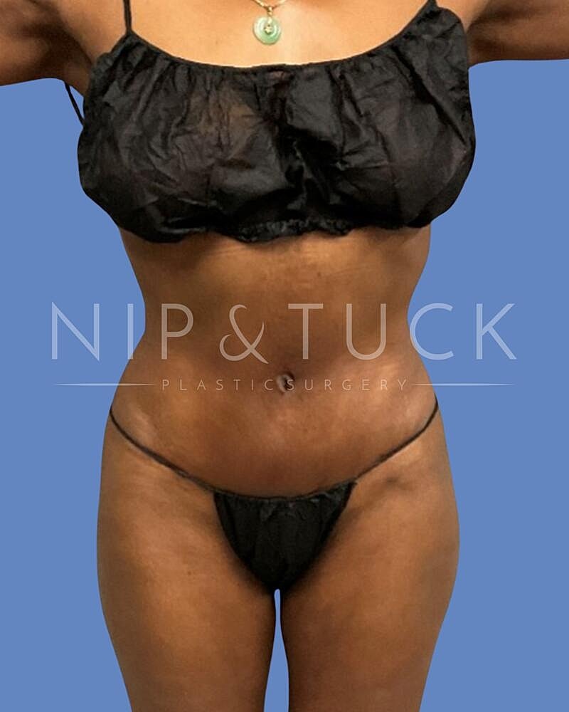 Brazilian Butt Lift Before & After