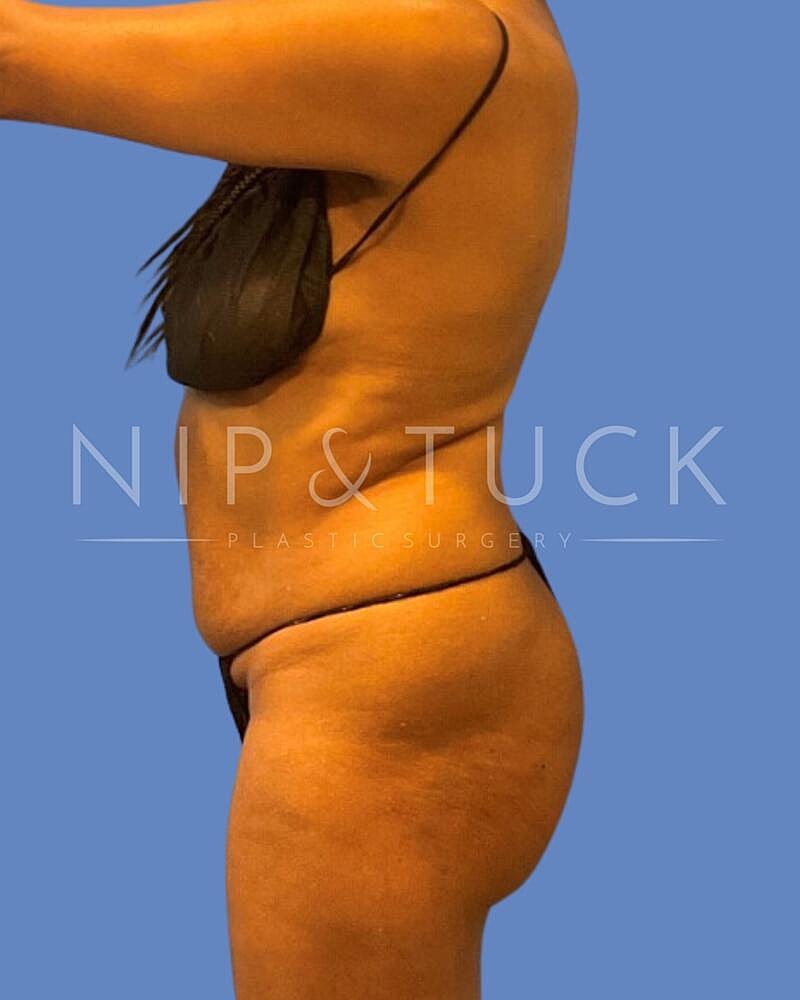 Brazilian Butt Lift Before & After