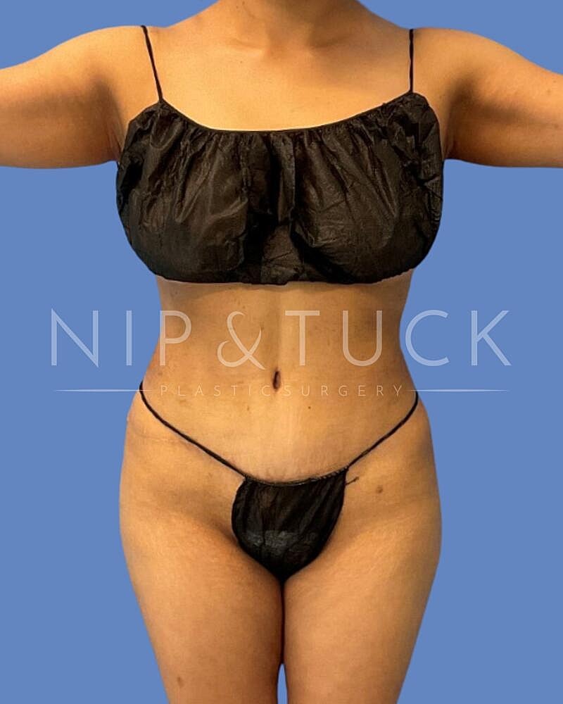 Brazilian Butt Lift Before & After