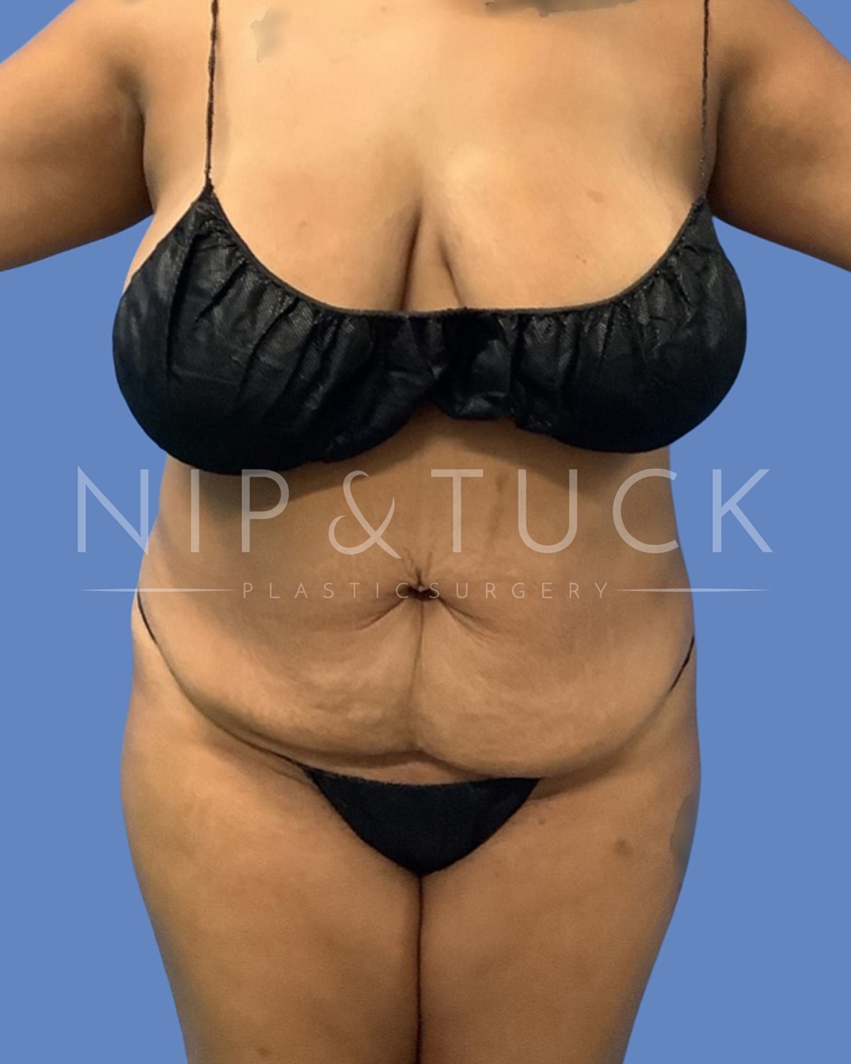 Brazilian Butt Lift Before & After